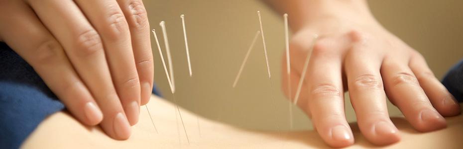Acupuncture Treatment  